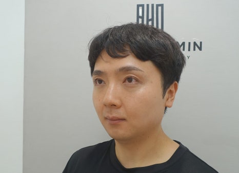 20대 남성 안검하수 증세와 눈매교정 수술 후 3개월 경과 관련 이미지 8