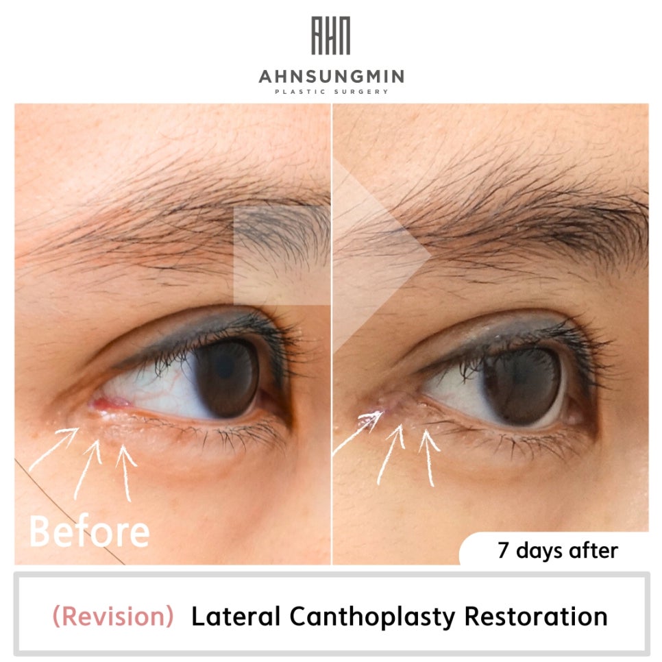 뒷트임복원, 올바른 시기와 뒷트임 복원 전후 관련 이미지 2