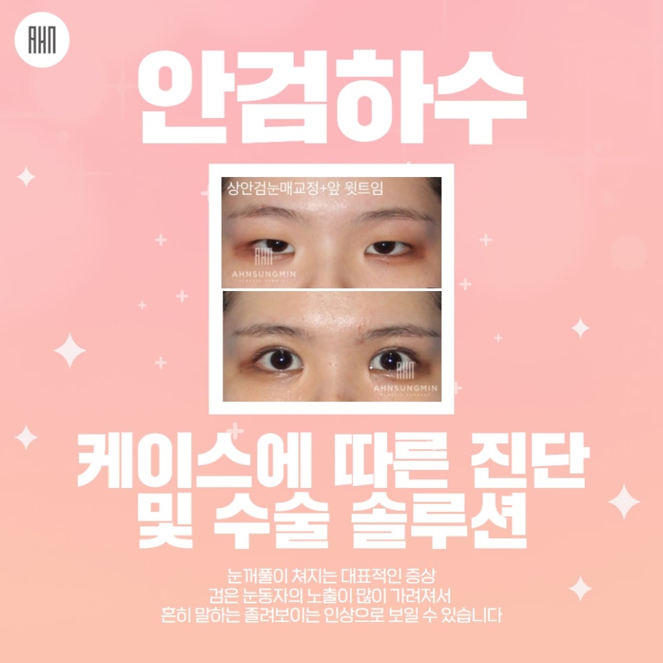 안검하수수술 또렷한 눈매를 원한다면 관련 이미지 1