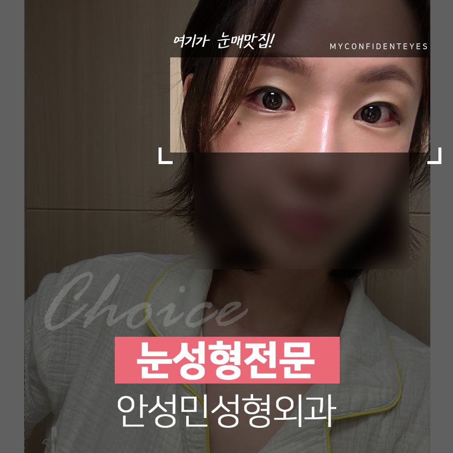 [잠실동성형외과] 눈성형의 시작은? 바로! 눈매맛집! 안성민성형외과 관련 이미지 1