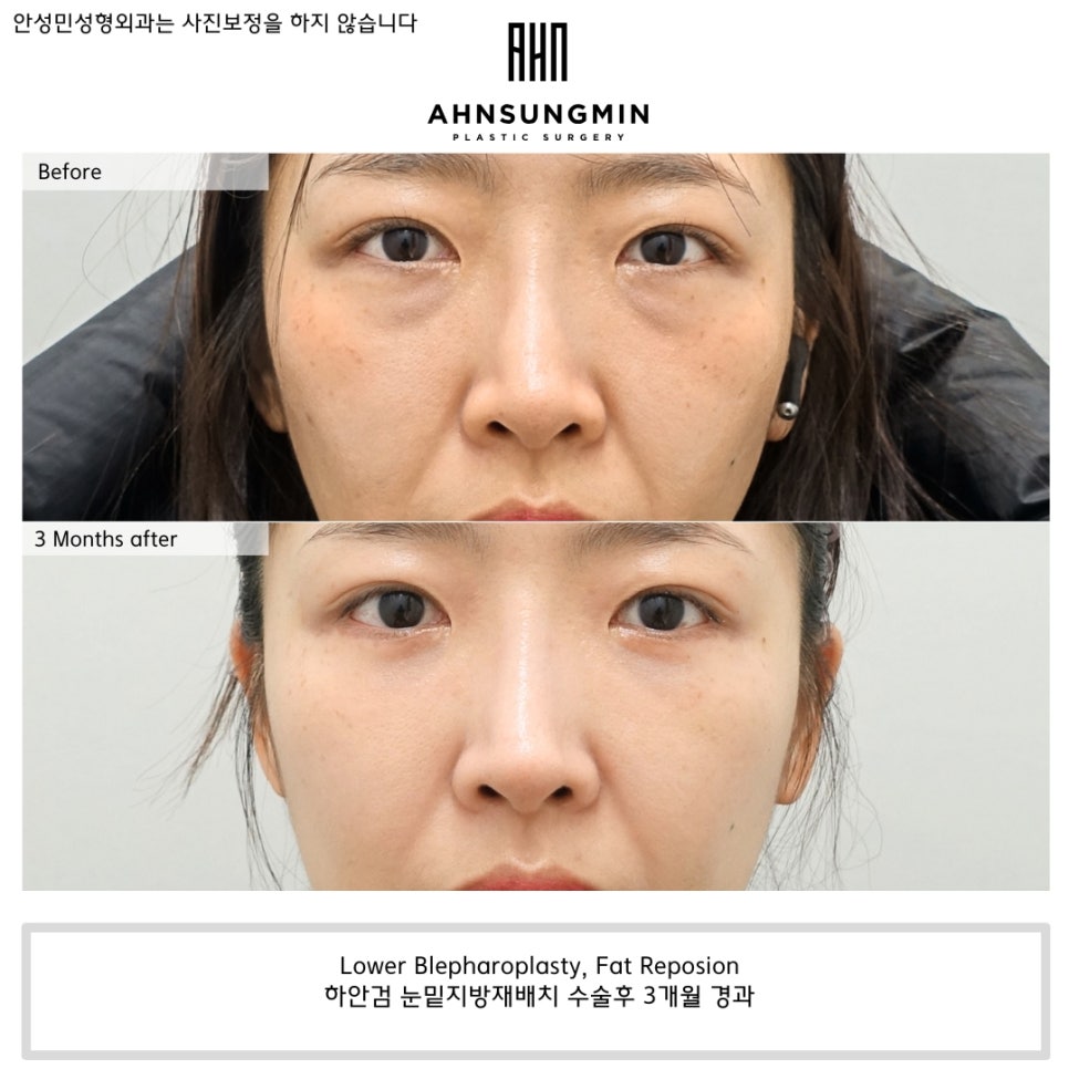 나이대별 눈밑지방재배치 수술 전후 사진 비교 관련 이미지 3