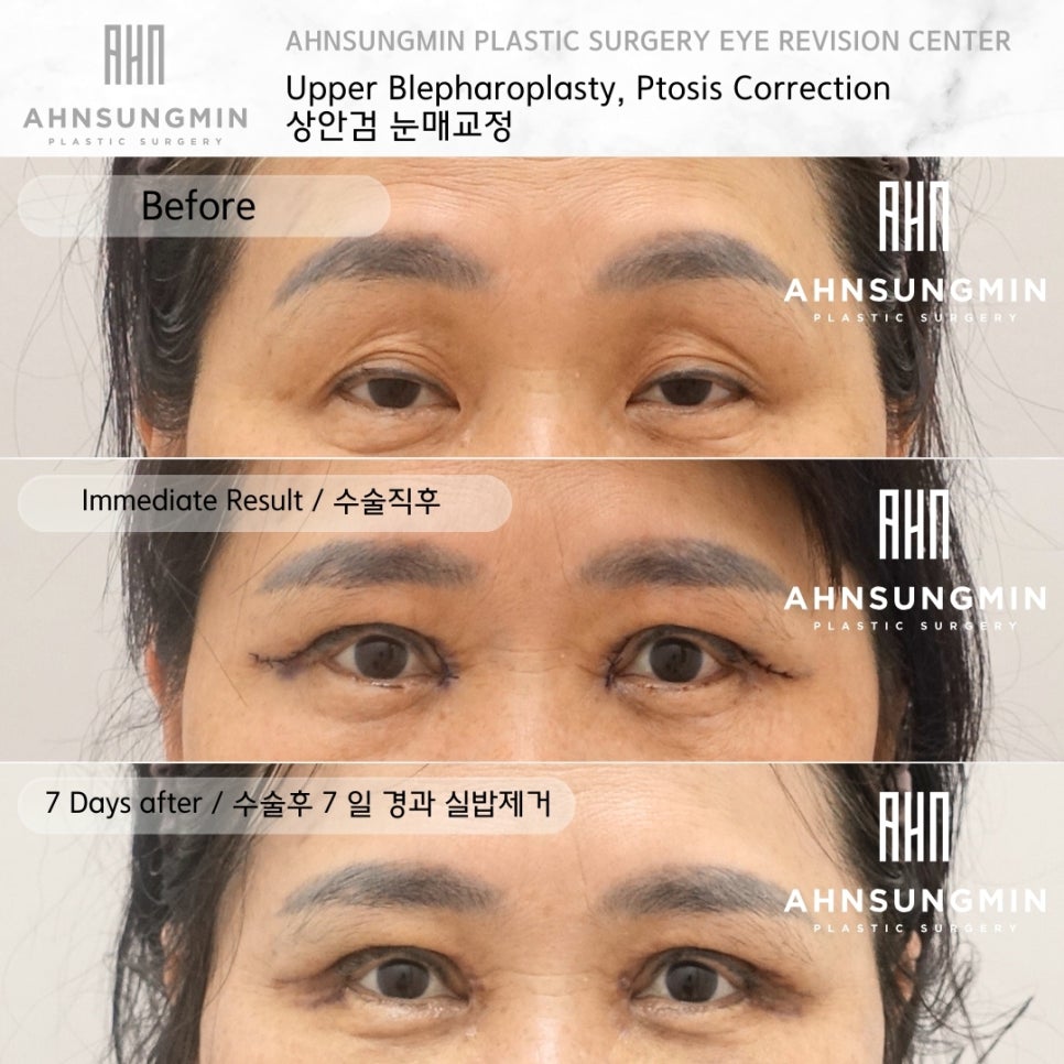 상안검 수술 잘하려면 [성형외과 전문의 안성민] 관련 이미지 4