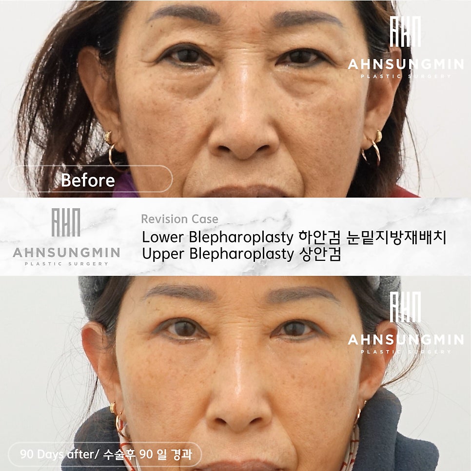 눈밑지방 재배치 재수술 후 3개월 경과 관련 이미지 1