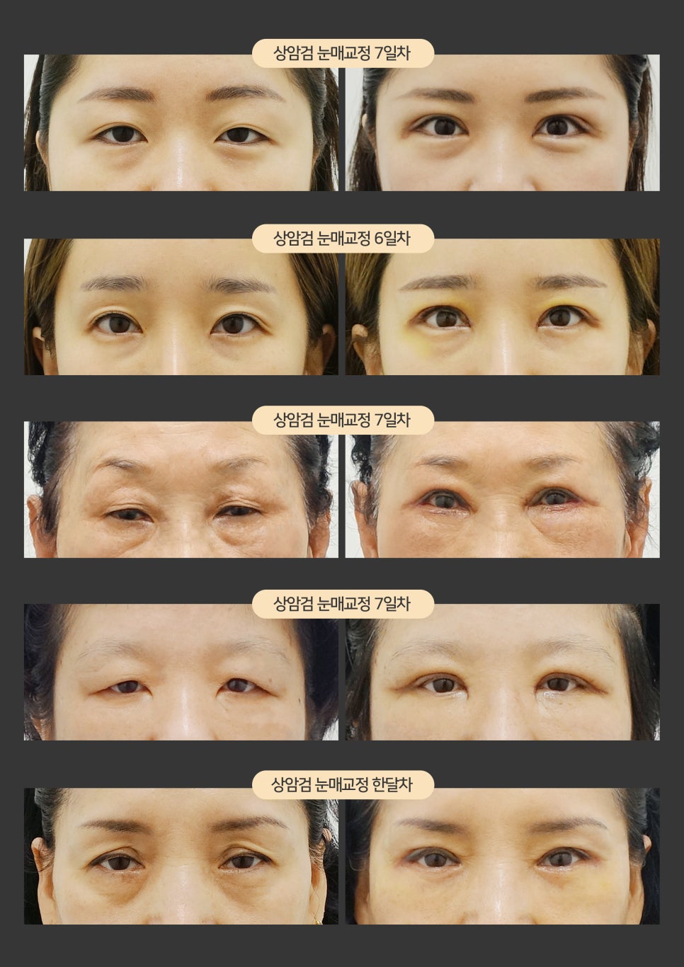 [잠실동성형외과] 결과로 증명하는 눈매교정 맛집! 매력적이게! 잠실성형외과 관련 이미지 3