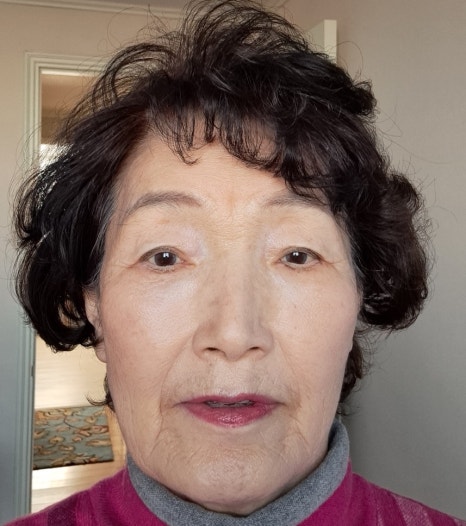 70대 여성 눈 밑 하안검 수술 회복 리얼 후기 관련 이미지 7