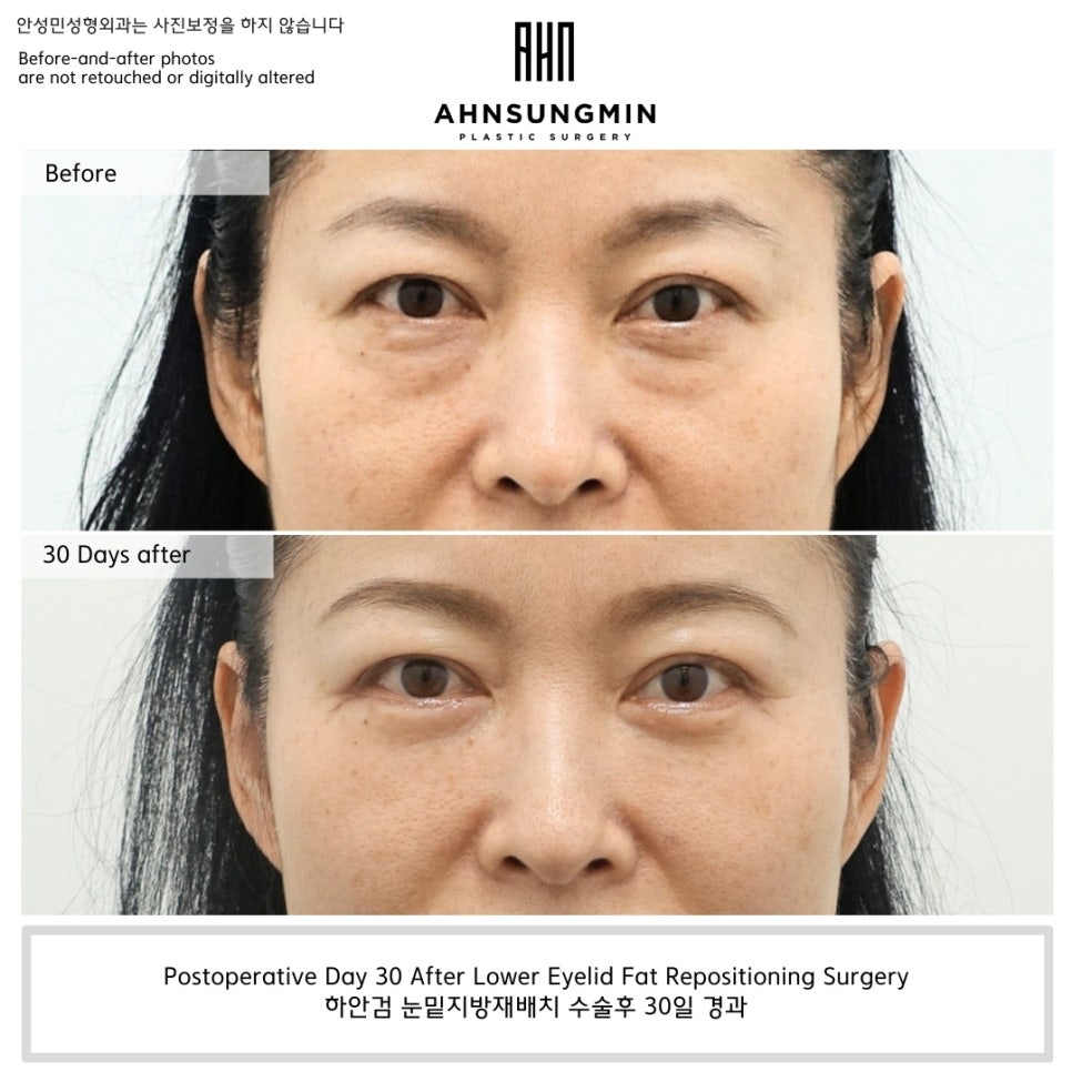 하안검 수술에서 애교살을 반드시 보존해야 하는 이유 관련 이미지 1