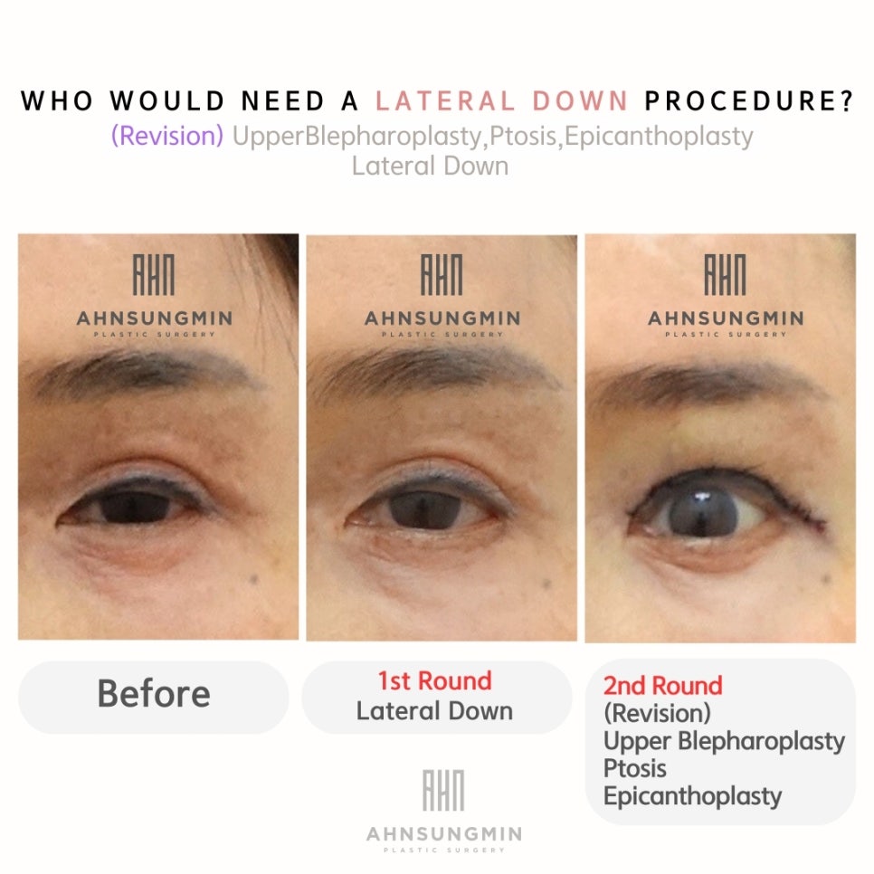 재수술의 경우 수술을 나눠서 진행하는 이유 관련 이미지 2