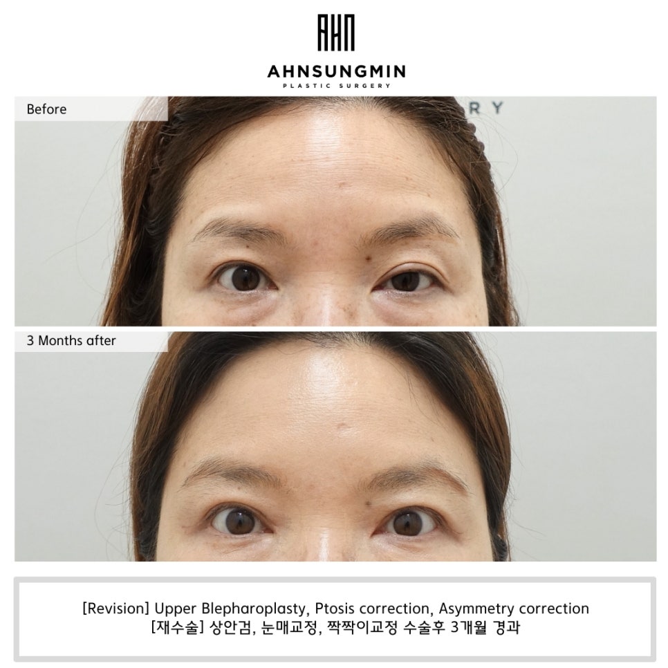 안검하수 짝짝이, 한쪽 눈만 교정하면 안 되는 이유 관련 이미지 1