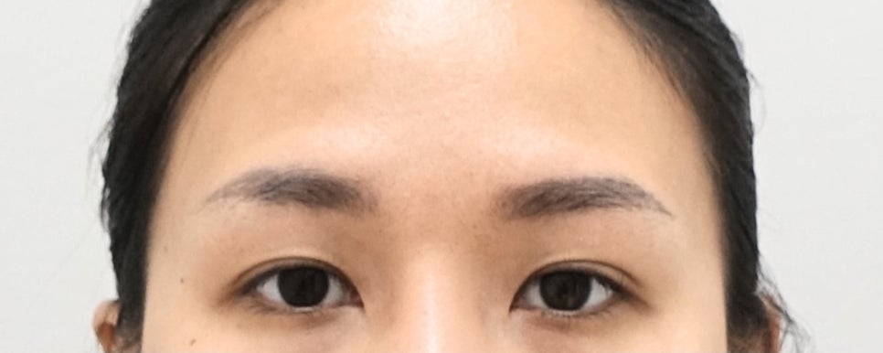 나이대별 상안검 수술 전후, 성형외과전문의 안성민 관련 이미지 7