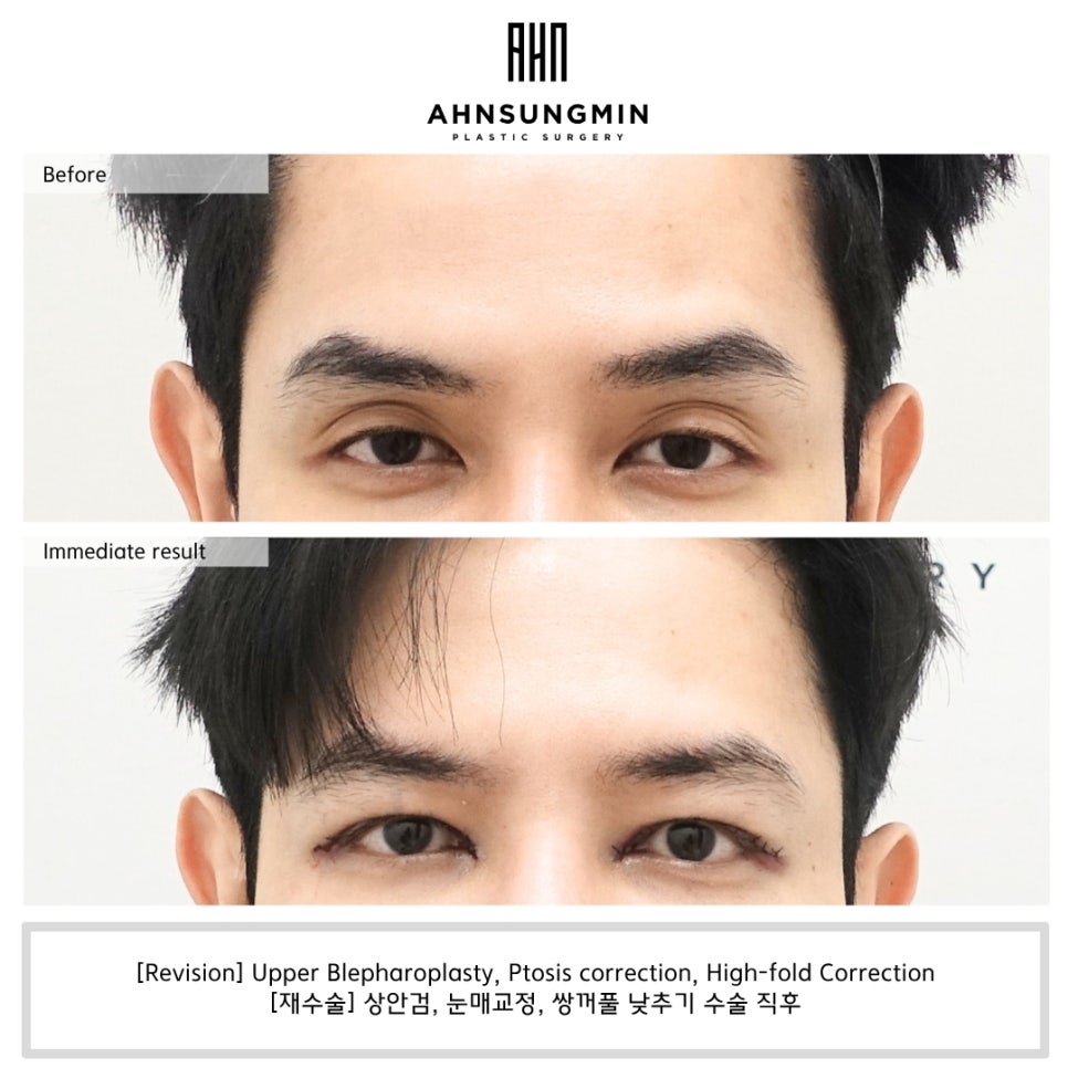 느끼한 남자눈 쌍꺼풀 낮추기 관련 이미지 5