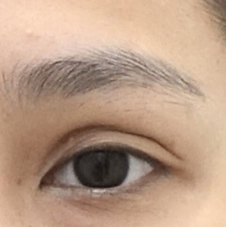 남자 눈성형 두꺼운 쌍꺼풀 풀기 관련 이미지 8