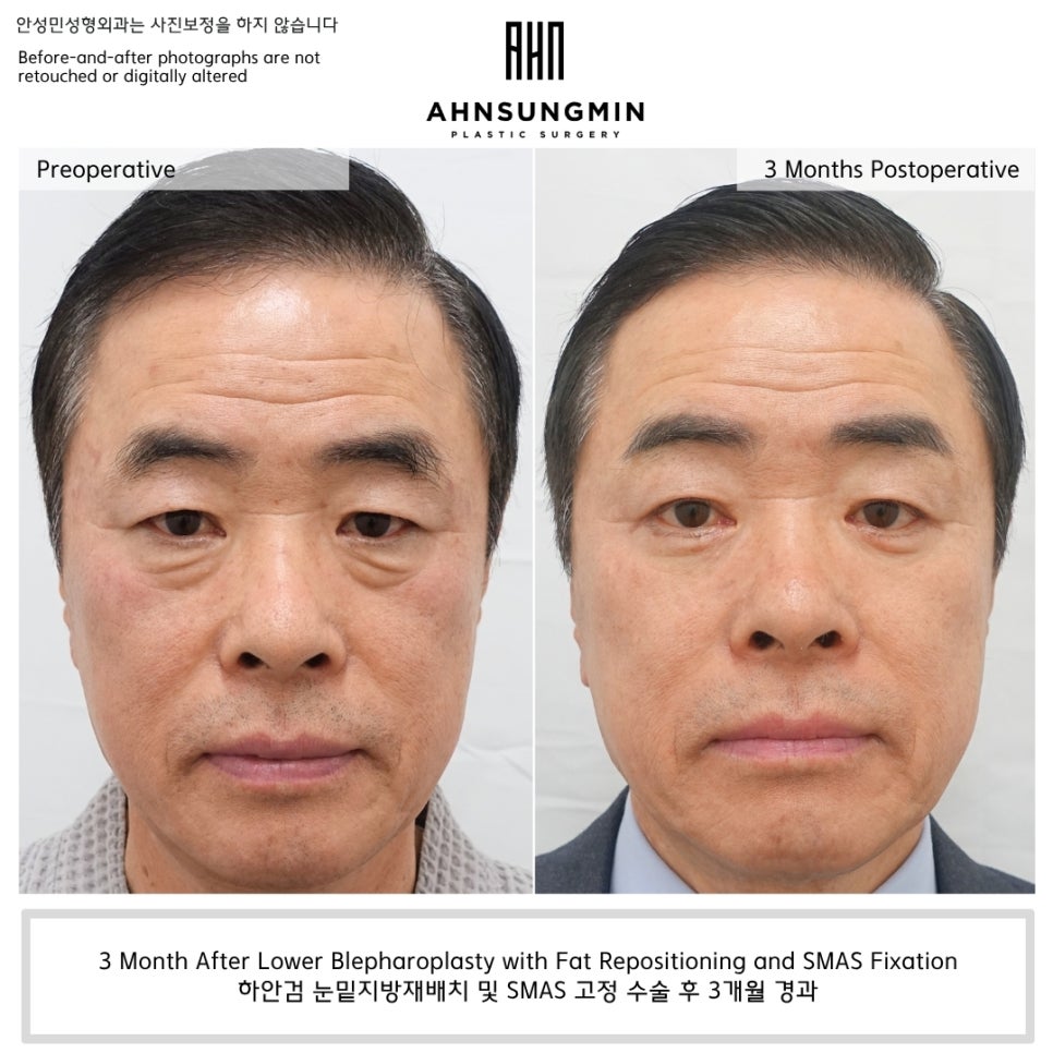 하안검 수술 후 회복 과정, 1주일&middot;1개월&middot;3개월 변화까지 직접 확인해보세요 관련 이미지 1