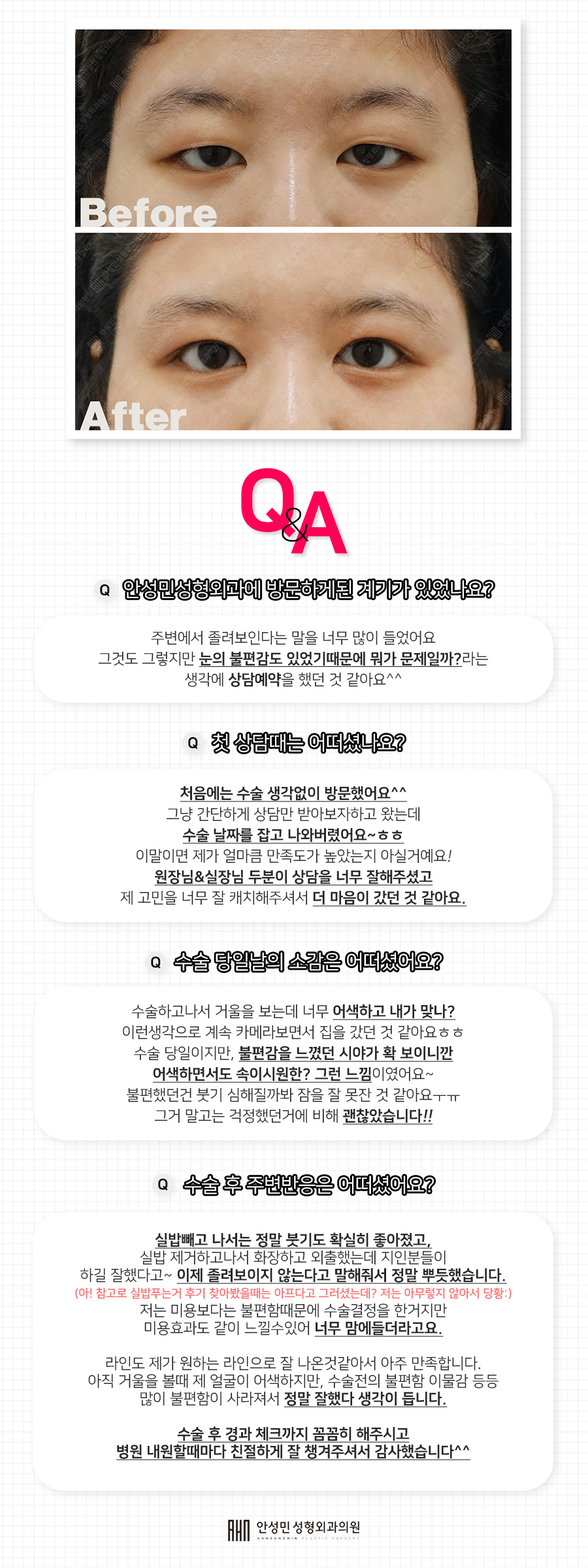 [잠실동성형외과] 상안검눈매교정 3개월차 후기 관련 이미지 2