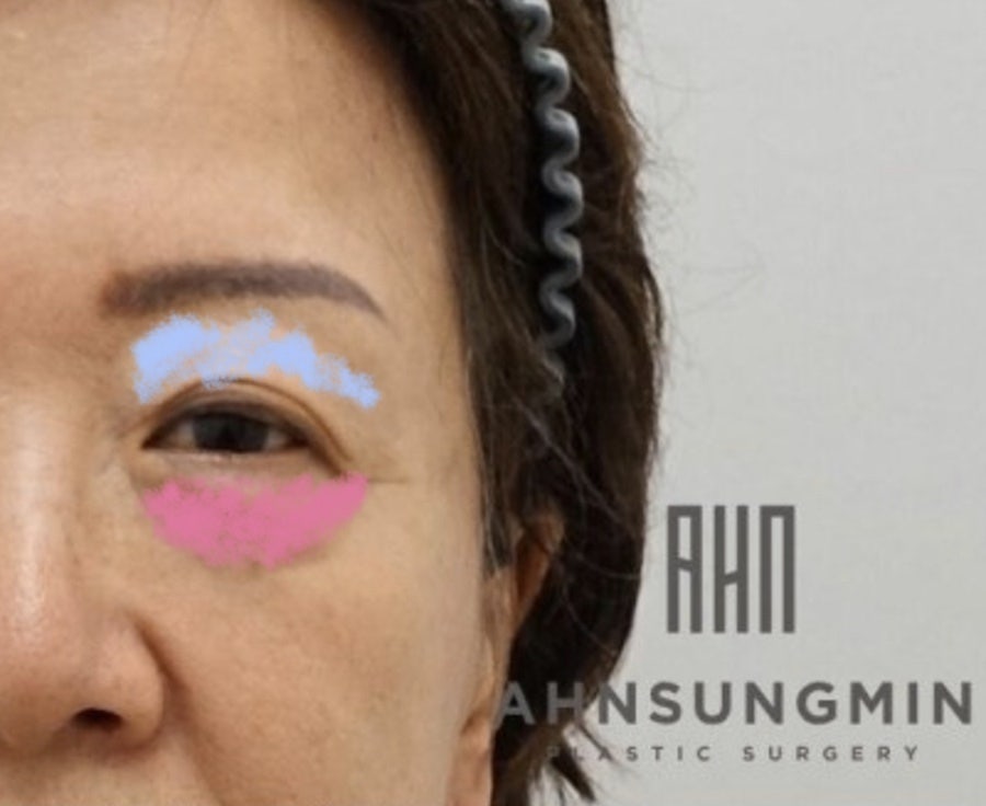 중년의 눈성형 하안검 수술방법 안성민원장님 관련 이미지 2