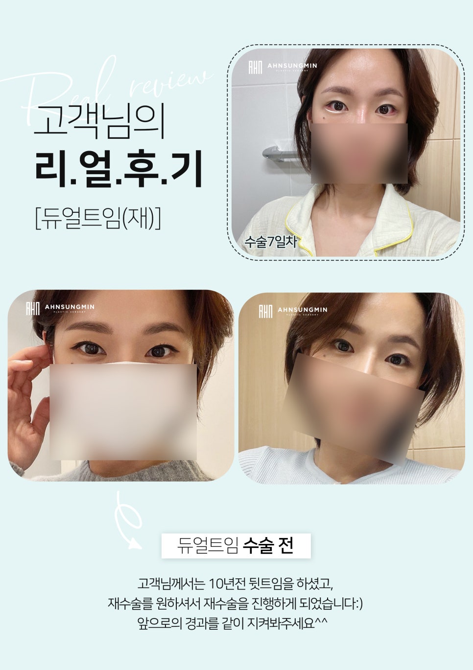 [잠실동성형외과] 듀얼트임 7일차 리얼후기 관련 이미지 1