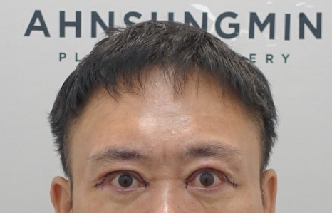 남자 짝짝이 쌍꺼풀 교정 후 32일 경과 [성형외과 전문의 안성민] 관련 이미지 4