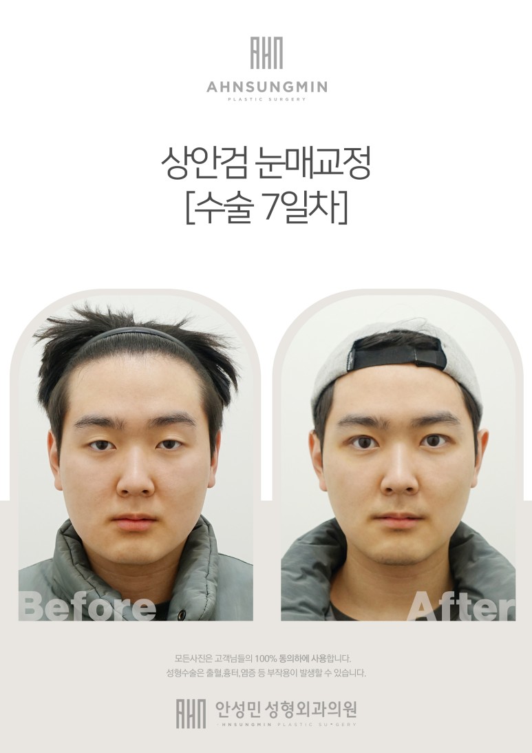 상안검 눈매교정 수술 관련 이미지 1