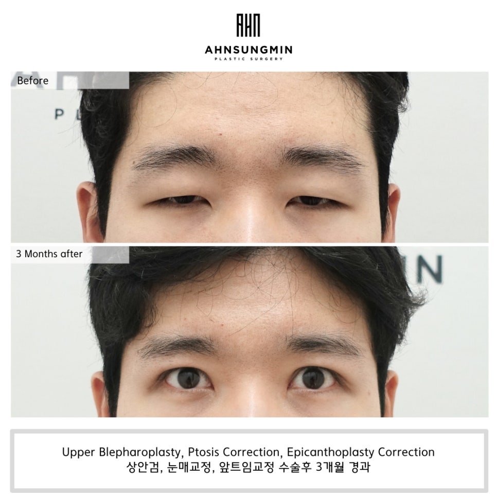 20대 중증 안검하수 수술 후 3개월 경과 관련 이미지 4