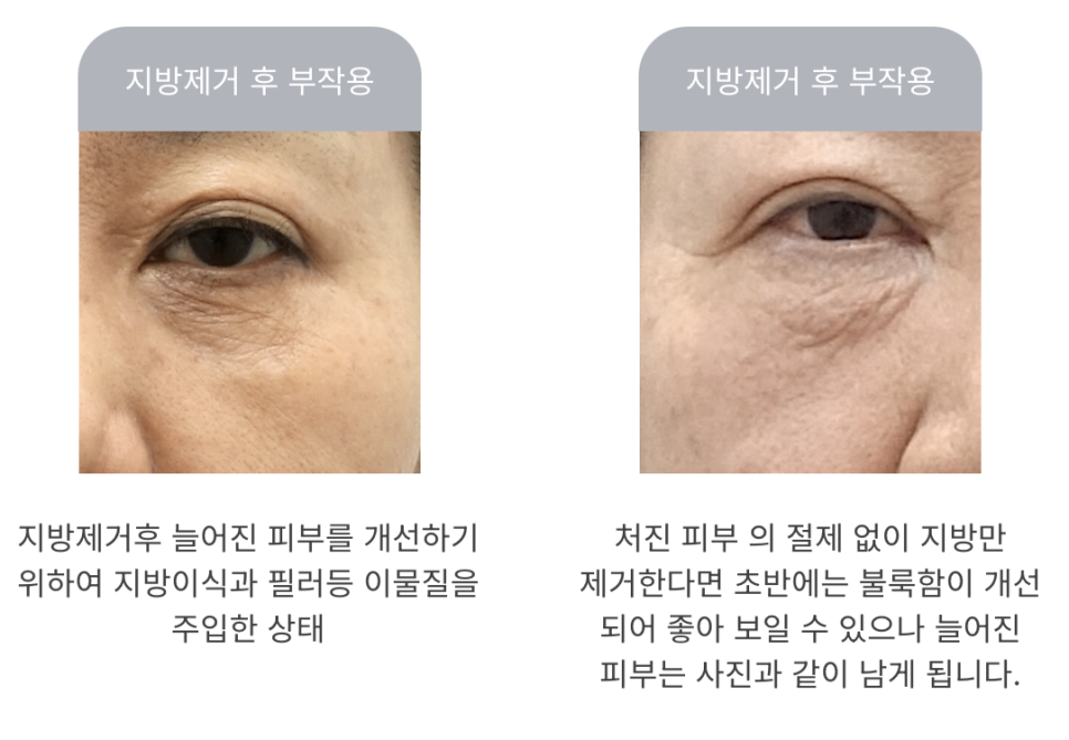 하안검 수술과 중안면 거상의 모든 것 관련 이미지 2