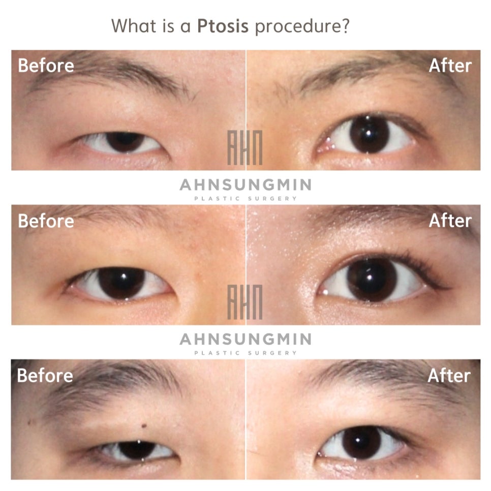 20대의 눈매교정 절개가 왜필요할까? [잠실안성민성형외과] 관련 이미지 2