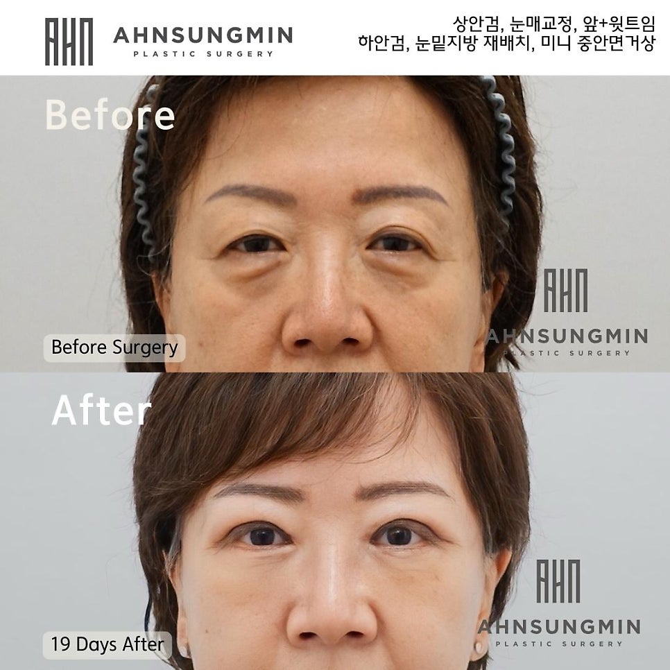 중년의 눈성형 하안검 수술방법 안성민원장님 관련 이미지 3