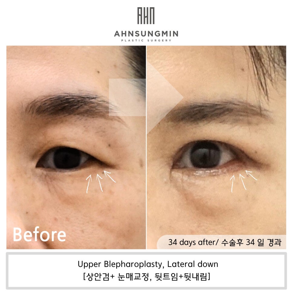 상안검 수술과 뒷트임 수술을 함께 진행하는 이유, 뒷트임의 중요성 관련 이미지 2