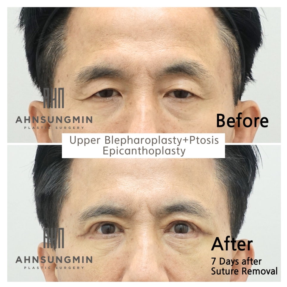중년남성 진성안검하수 눈매교정 상안검성형[성형외과전문의] 관련 이미지 2