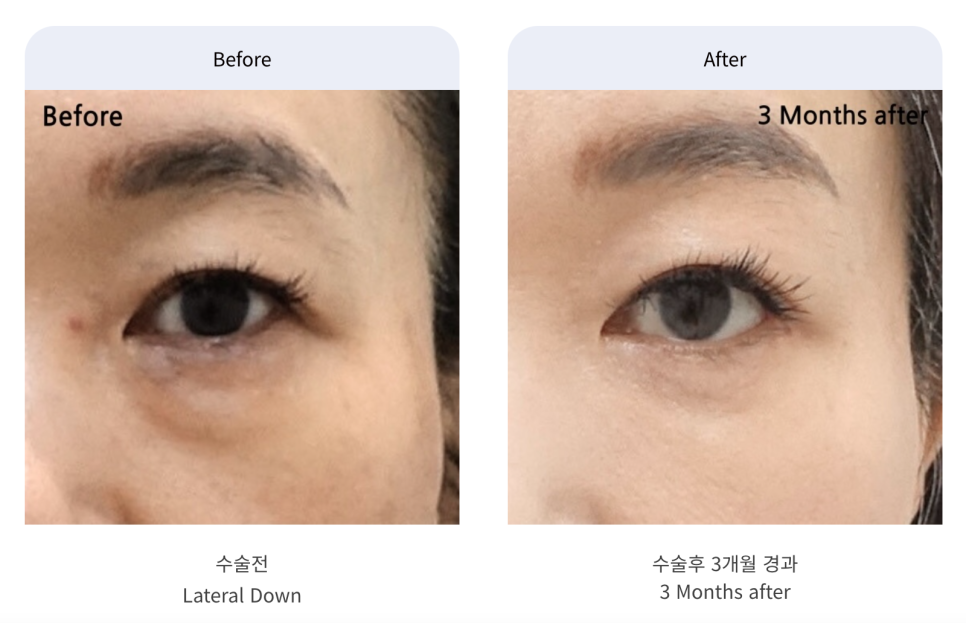 트임 성형의 모든 것 뒤트임, 뒷내림, 밑트임 관련 이미지 6