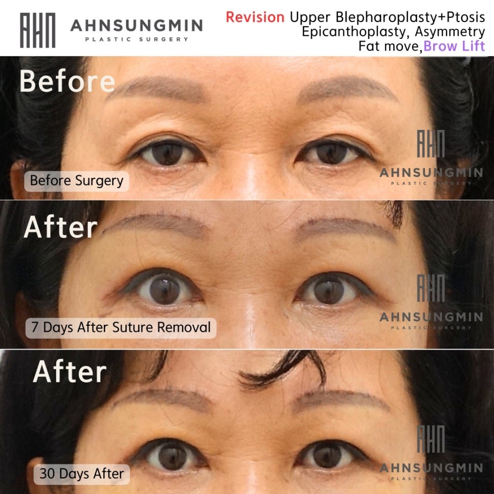 중년여성의 상안검과 눈썹상거상 관련 이미지 2