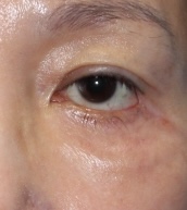 안검외반 교정 복원 전후 관련 이미지 3