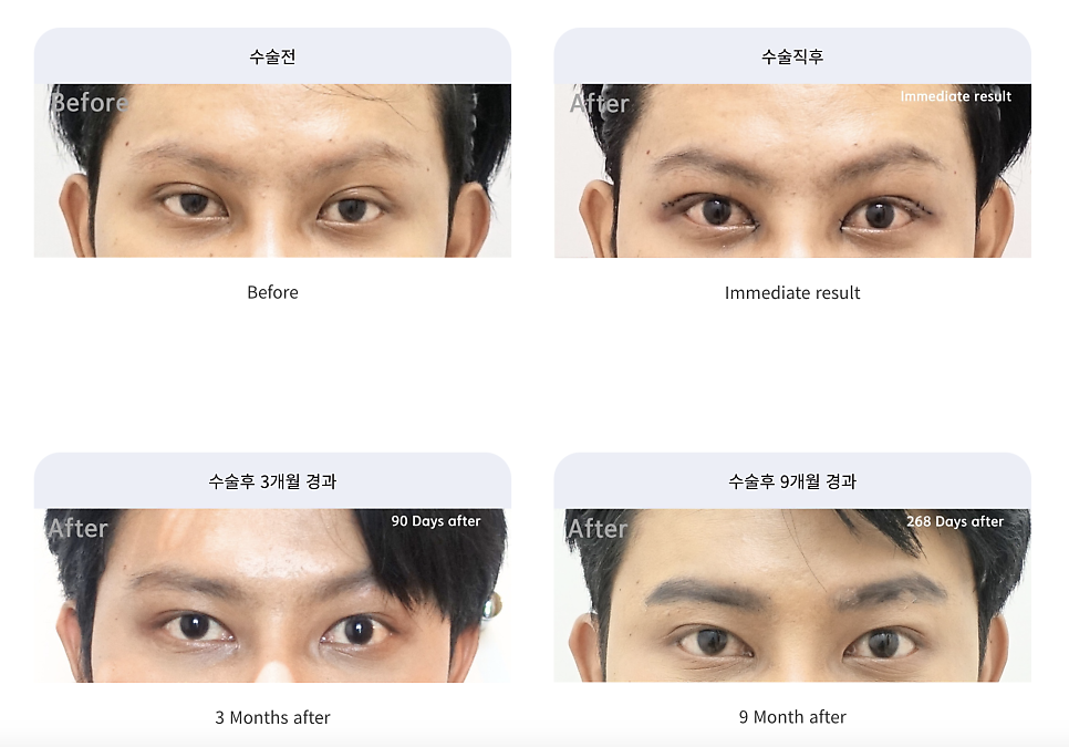 소세지눈 쌍꺼풀 풀기 재수술로 해결 관련 이미지 3