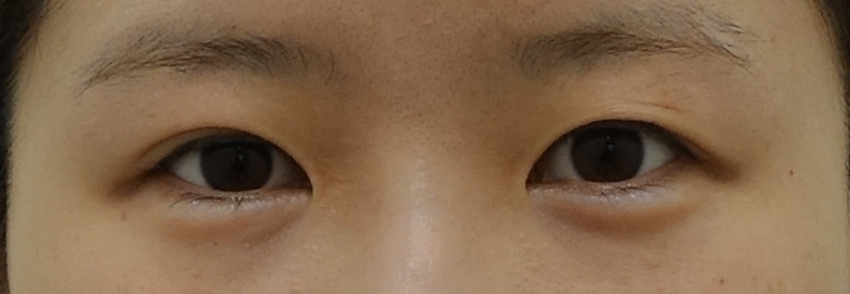 성형외과전문의 안성민이 말하는 트임수술 관련 이미지 3