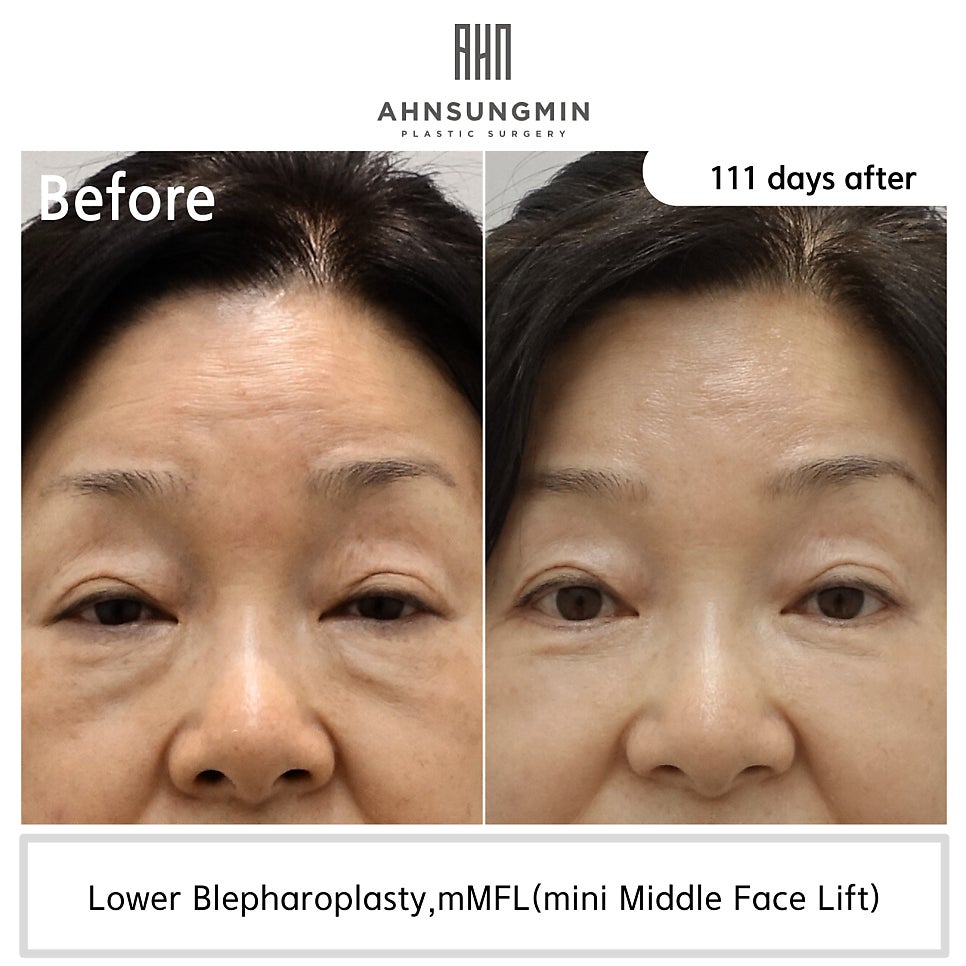 중년 눈 밑 지방재배치 애굣살(애교살) 보존 이유 관련 이미지 2