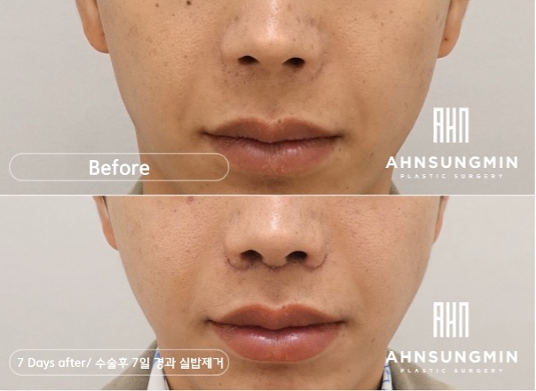 인중축소 수술이란? 관련 이미지 2