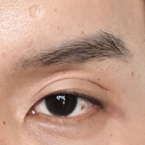 남자 눈성형 두꺼운 쌍꺼풀 풀기 관련 이미지 6