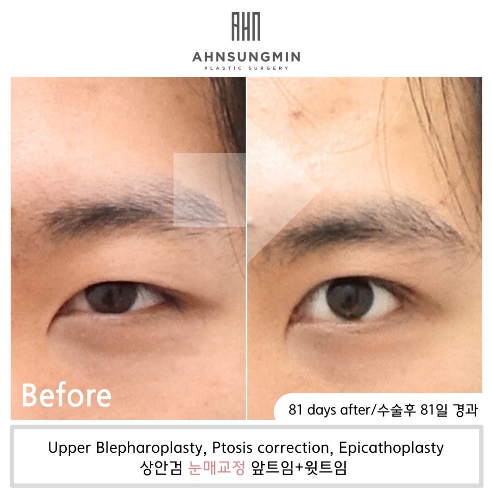 생기있는 남자 눈매완성, 안검하수 눈매교정 관련 이미지 2