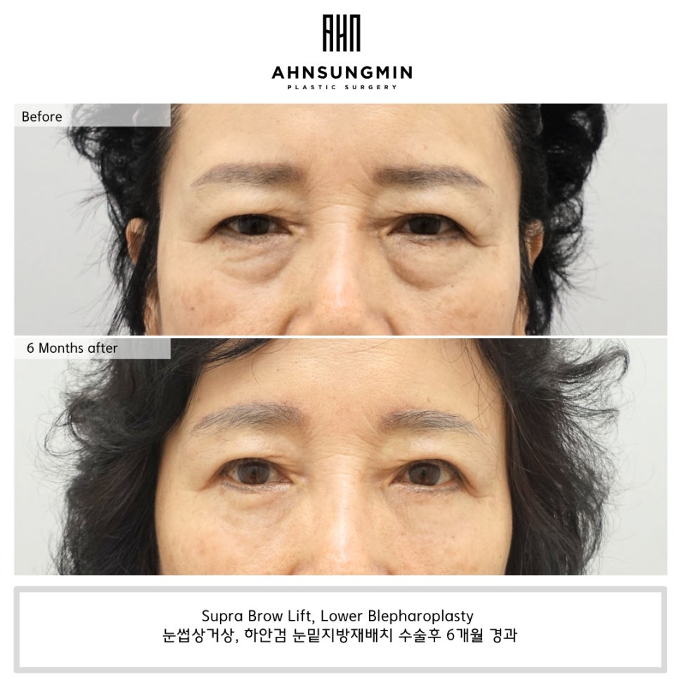 눈꺼풀 처짐을 해결하는 방법, 눈썹 거상 수술이 필요한 경우 관련 이미지 3