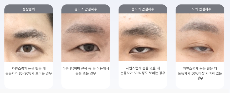 잠실새내역 성형외과 남자 안검하수 눈매교정 전문 관련 이미지 1