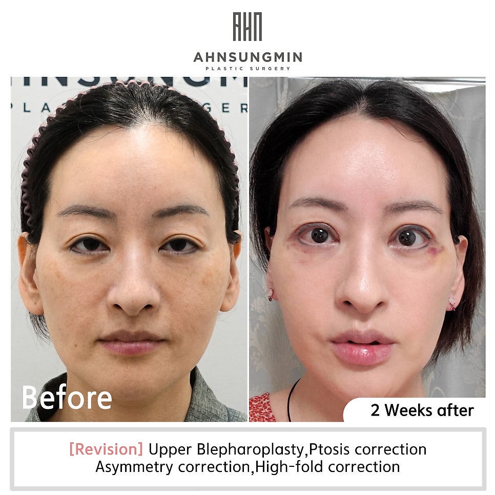 눈매교정 짝짝이 저교정 재수술[성형외과 전문의 안성민 대표원장] 관련 이미지 3