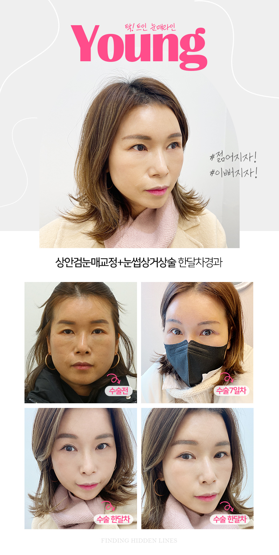 [잠실동성형외과] 상안검눈매교정 + 눈썹상거상술 수술후기 / 한달차경과 / 동안페이스 / 잠실성형외과 관련 이미지 1