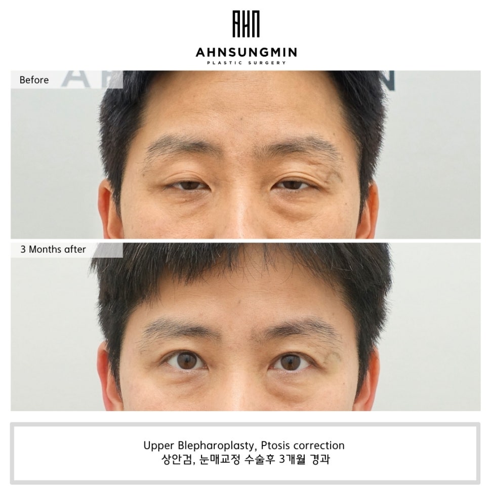 남자 안검하수, 눈이 커지고 싶어요 관련 이미지 1