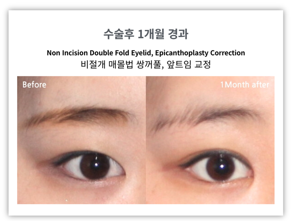 절개쌍꺼풀과 비절개쌍꺼풀 비교 관련 이미지 1