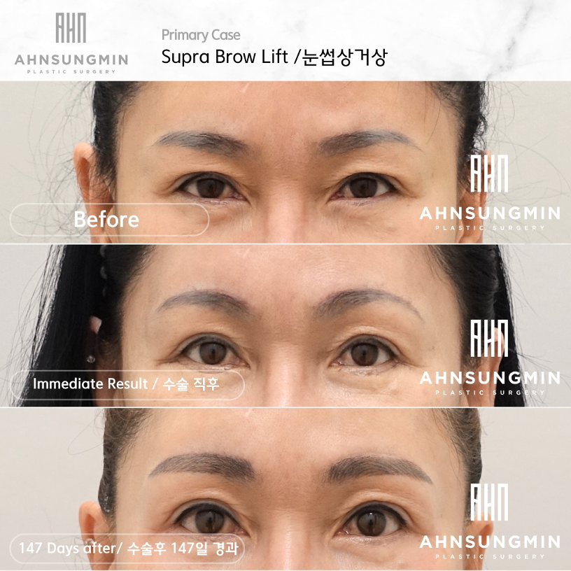 눈썹거상 수술 과정, 5개월 경과 성형외과 전문의 안성민 관련 이미지 3