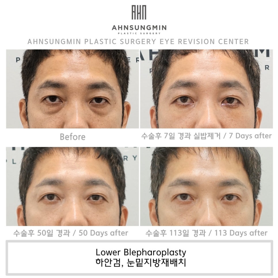 중년 남성의 하안검, 나도 젊어질 수 있을까? 관련 이미지 4