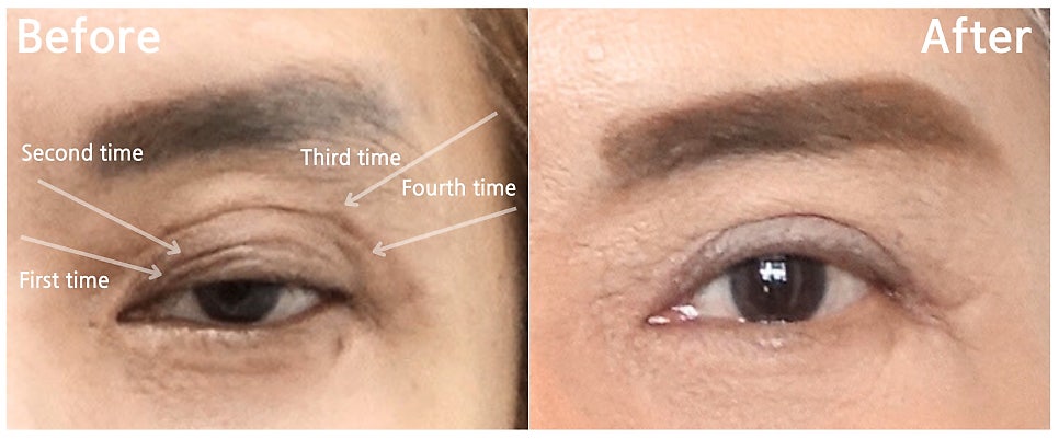 여러 번의 수술로 인한 겹주름, 왜 생길까? 관련 이미지 2