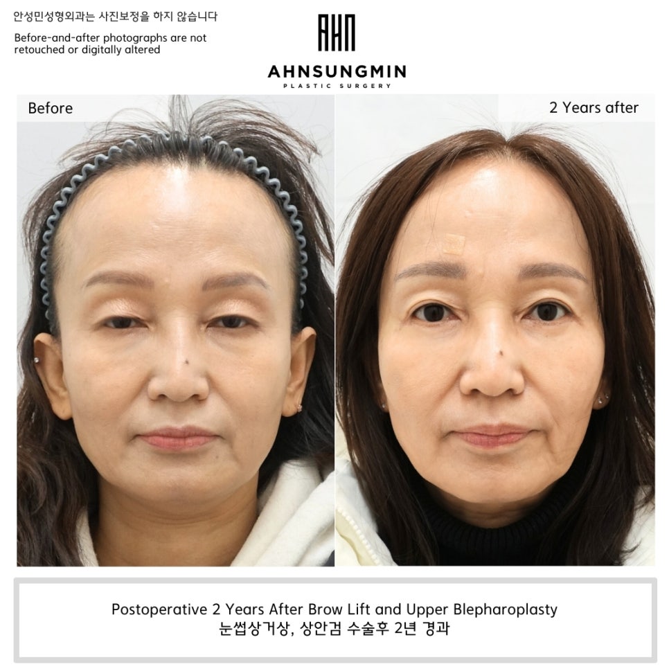 눈썹상거상과 상안검 수술 함께 시행한 경우 &mdash; 2년 후 경과 관련 이미지 1