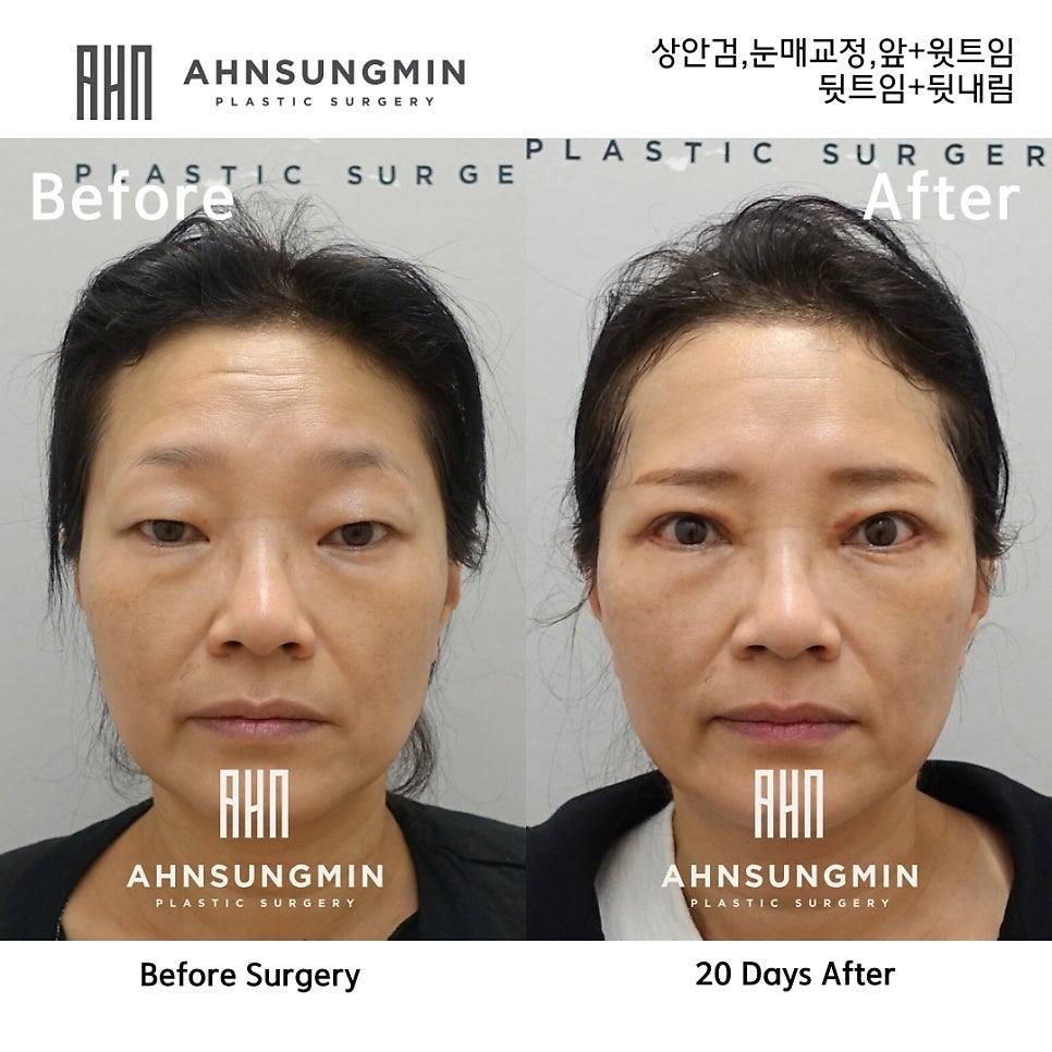 이마주름의 이유는 눈 때문입니다 관련 이미지 2