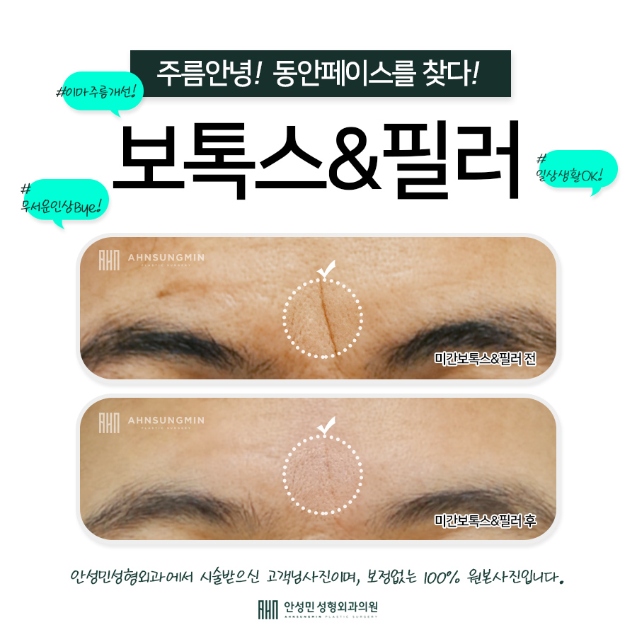 [잠실동성형외과] 미간 필러+보톡스 효과후기 관련 이미지 1