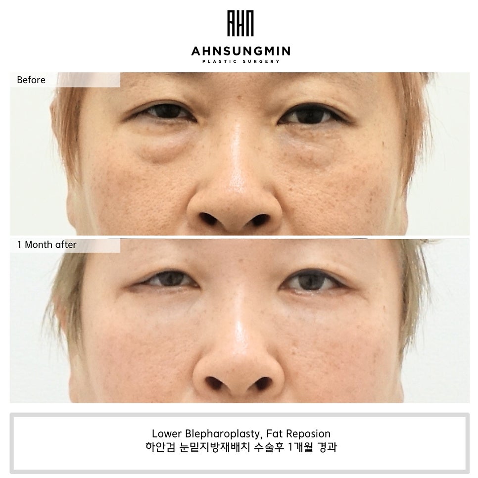 나이대별 눈 밑 수술 전후 [성형외과 전문의 안성민] 관련 이미지 3