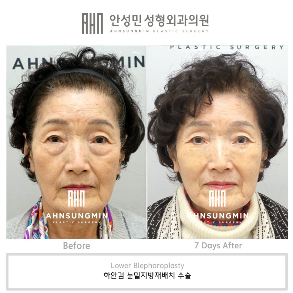 노년의 하안검 수술 주의점, 70대 여성 하안검 눈밑지방재배치 첫수술 관련 이미지 1